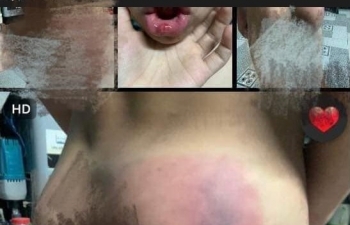 Làm rõ thông tin cô giáo dùng thước gỗ đánh học sinh bầm tím