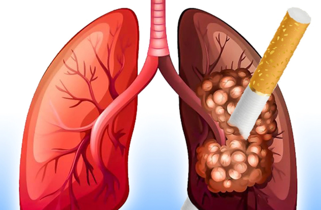 Thuốc lá: Thủ phạm gây bệnh phổi tắc nghẽn mạn tính