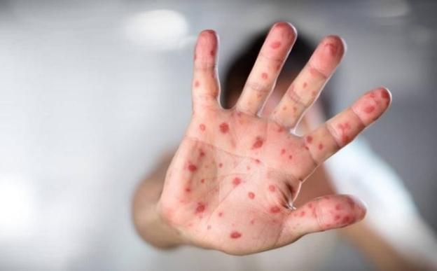 Virus mới khiến trẻ mắc tay chân miệng chuyển nặng, tử vong nhanh