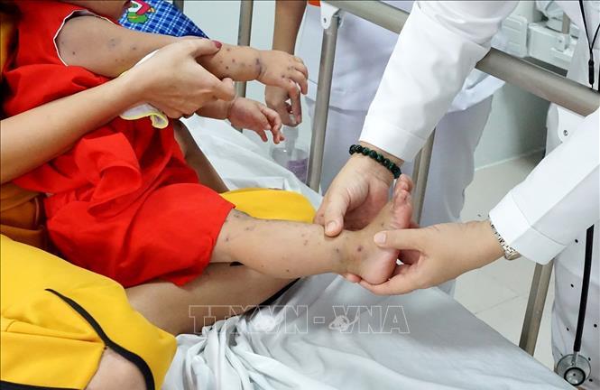 Bộ Y tế cảnh báo gia tăng bệnh tay chân miệng đầu năm học mới