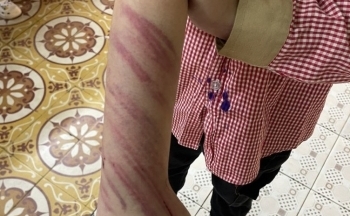 Hải Phòng: Xác minh việc bé trai 8 tuổi bị bạn trai của mẹ bạo hành