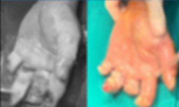 Quảng Ninh: Ba người bị máy cưa cắt vào tay trong cùng một ngày