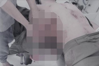 Quảng Ninh: Một người bị thương nặng do dùng mìn tự chế