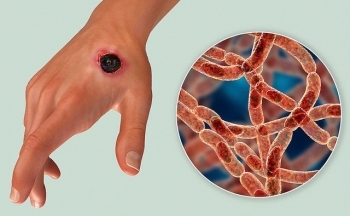 Bộ Y tế cập nhật thông tin mới nhất về tình hình dịch bệnh than trên người