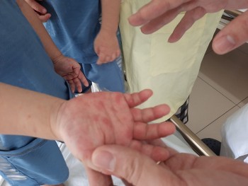 Tin nóng y tế: Đã có 21 ca tử vong do tay chân miệng