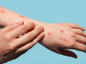 Đồng Nai: Ghi nhận ca bệnh đậu mùa khỉ đầu tiên