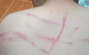 Thanh Hóa: Đình chỉ công tác cô giáo đánh học sinh lớp 4 bầm tím lưng