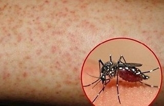 Cách phòng ngừa và điều trị sốt xuất huyết theo quy định của Bộ Y tế