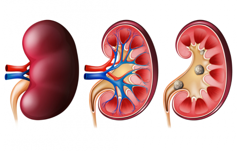 Những loại nước ngăn ngừa sỏi thận không thể bỏ qua