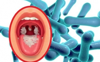 Bệnh bạch hầu: Cảnh báo mức độ nguy hiểm và dấu hiệu nhận biết
