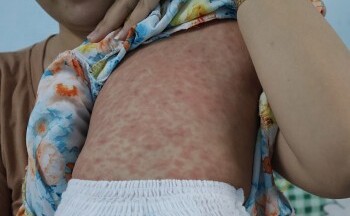 TP. Hồ Chí Minh chính thức công bố dịch sởi