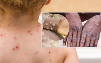 Thanh Hóa: Tăng cường công tác phòng, chống dịch Đậu mùa khỉ