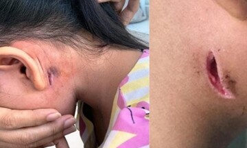 Nhiều người nhiễm vi khuẩn ăn thịt người, Bộ Y tế ra khuyến cáo