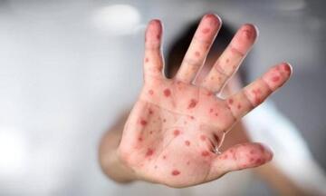 Virus mới khiến trẻ mắc tay chân miệng chuyển nặng, tử vong nhanh