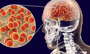 Gia tăng ca mắc não mô cầu: Phòng ngừa cách nào?