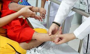 Bộ Y tế cảnh báo gia tăng bệnh tay chân miệng đầu năm học mới