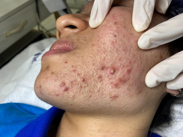 Một trường hợp bị mụn khá nặng
