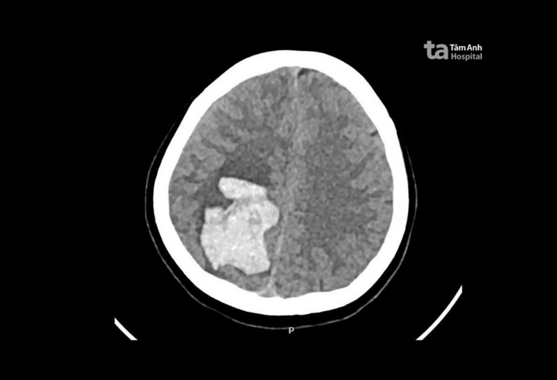 Kết quả chụp CT sọ não cho thấy ổ xuất huyết lớn trong não bệnh nhân - Ảnh: Bệnh viện cung cấp