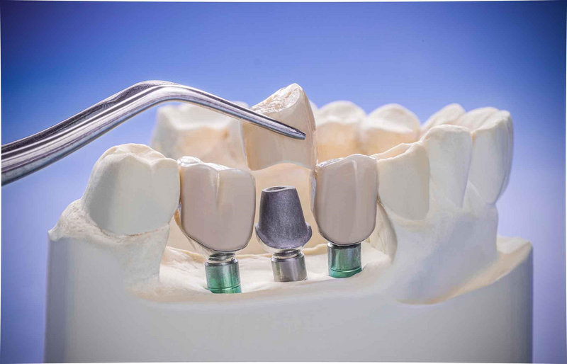 Với những người trẻ, thời gian tương thích giữa trụ Implant và xương sẽ nhanh hơn