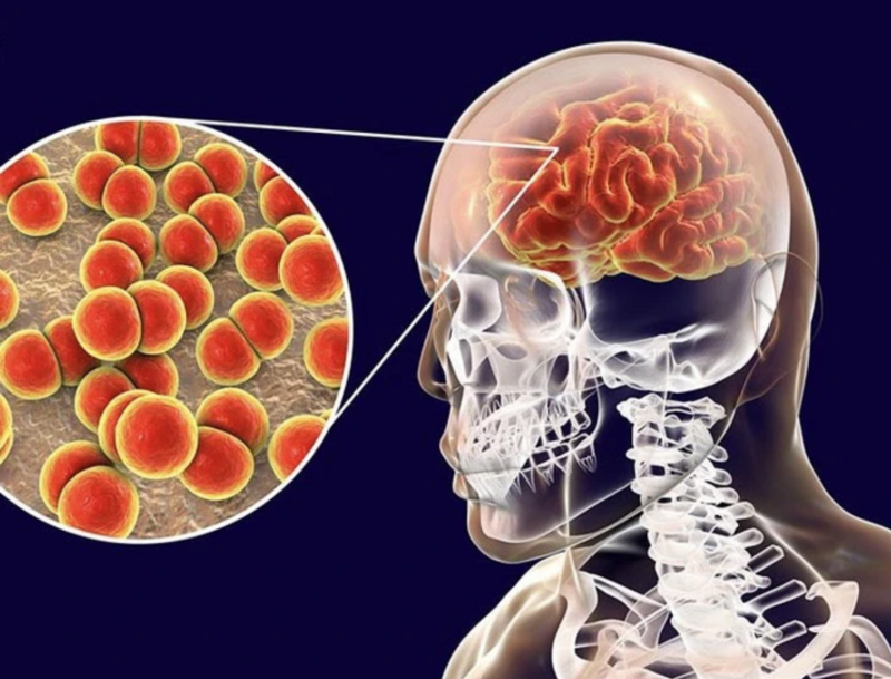 Nguyên nhân bệnh viêm màng não mô cầu là do vi khuẩn Neisseria meningitidis lây truyền qua đường hô hấp khi tiếp xúc gần với người bị nhiễm hoặc người lành mang vi khuẩn. Ảnh minh họa