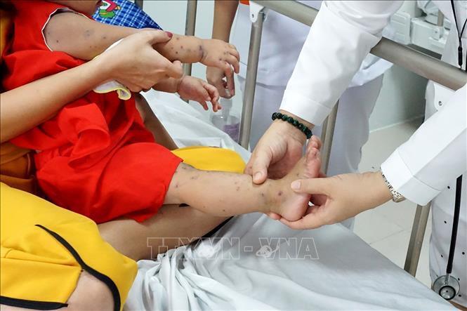 Trẻ em bị bệnh tay chân miệng đang điều trị tại bệnh viện.
