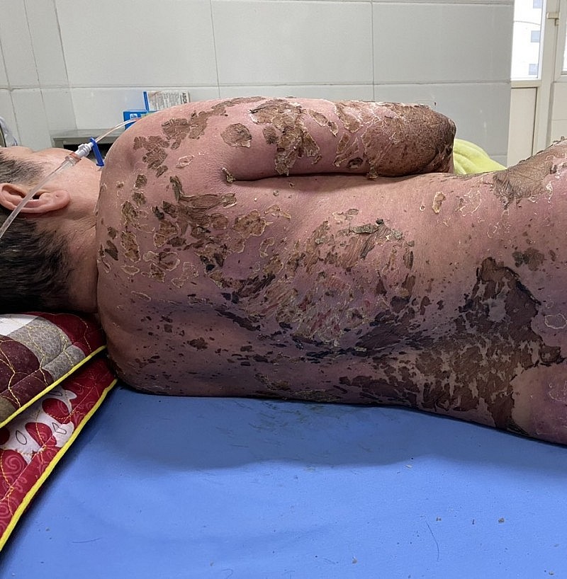 Bệnh viện đa khoa tỉnh Thanh Hóa cứu sống bệnh nhân dùng thuốc nam không rõ nguồn gốc Bệnh viện đa khoa tỉnh Thanh Hóa cứu sống bệnh nhân dùng thuốc nam không rõ nguồn gốc