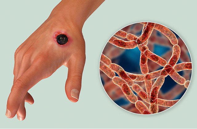 Bộ Y tế cập nhật thông tin mới nhất về tình hình dịch bệnh than trên người - Ảnh 1. Bộ Y tế cập nhật thông tin mới nhất về tình hình dịch bệnh than trên người - Ảnh 1.