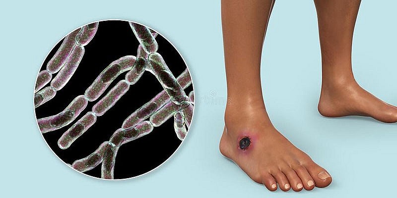 Bệnh than hay còn có tên gọi khác là bệnh nhiệt than thuộc nhóm các loại bệnh truyền nhiễm gây ra bởi loại vi khuẩn gram dương, hình que Bacillus anthracis. Loại vi khuẩn này thường tồn tại trong điều kiện tự nhiên trong đất hoặc ký sinh trên các loại động vật nuôi hoặc động vật hoang dã. Bệnh than hay còn có tên gọi khác là bệnh nhiệt than thuộc nhóm các loại bệnh truyền nhiễm gây ra bởi loại vi khuẩn gram dương, hình que Bacillus anthracis. Loại vi khuẩn này thường tồn tại trong điều kiện tự nhiên trong đất hoặc ký sinh trên các loại động vật nuôi hoặc động vật hoang dã.