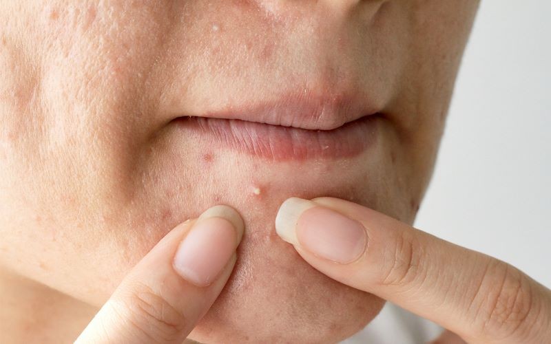 Việc nặn mụn bằng tay hình thành nên các mụn mới. Ảnh internet Việc nặn mụn bằng tay hình thành nên các mụn mới. Ảnh internet