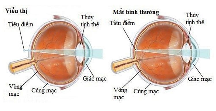 Nguyên nhân gây viễn thị và cách điều trị Nguyên nhân gây viễn thị và cách điều trị