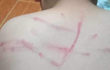 Thanh Hóa: Đình chỉ công tác cô giáo đánh học sinh lớp 4 bầm tím lưng