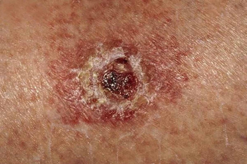 nốt ruồi bất thường, mọc không đối xứng, màu sắc không đều, nhô quá nhiều lên trên hoặc lõm nhiều xuống dưới da... chính là đặc điểm nhận biết ung thư da nốt ruồi bất thường, mọc không đối xứng, màu sắc không đều, nhô quá nhiều lên trên hoặc lõm nhiều xuống dưới da... chính là đặc điểm nhận biết ung thư da
