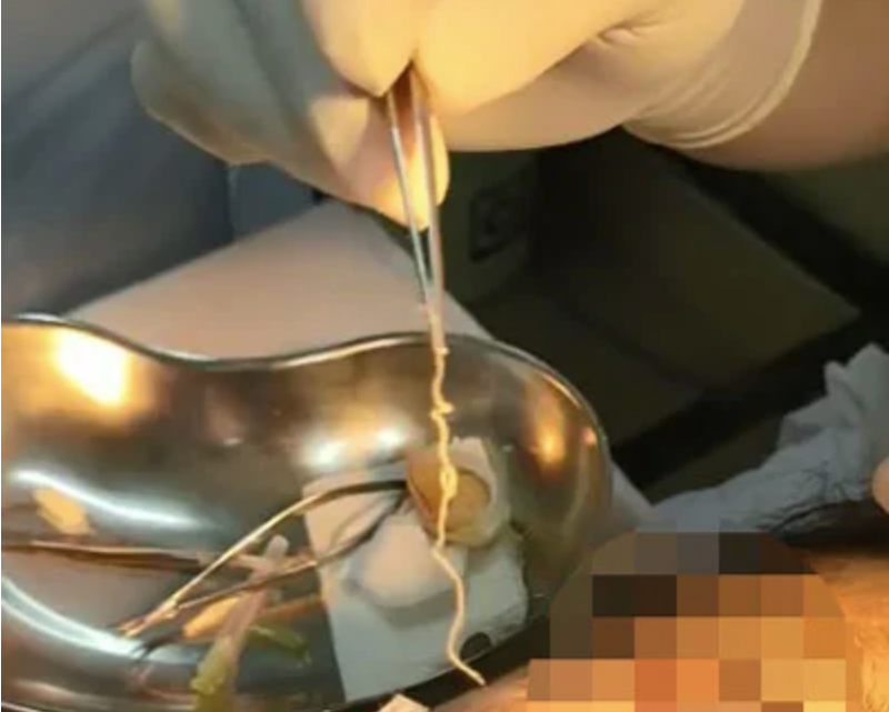 Các bác sĩ gắp thành công con giun dài 10cm trong mắt người phụ nữ Các bác sĩ gắp thành công con giun dài 10cm trong mắt người phụ nữ