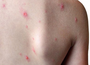 Cà Mau chính thức xác nhận có ca bệnh đậu mùa khỉ đầu tiên