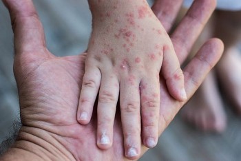 Cách phát hiện nhanh dấu hiệu trẻ bị bệnh tay chân miệng để tránh trở nặng, nguy kịch