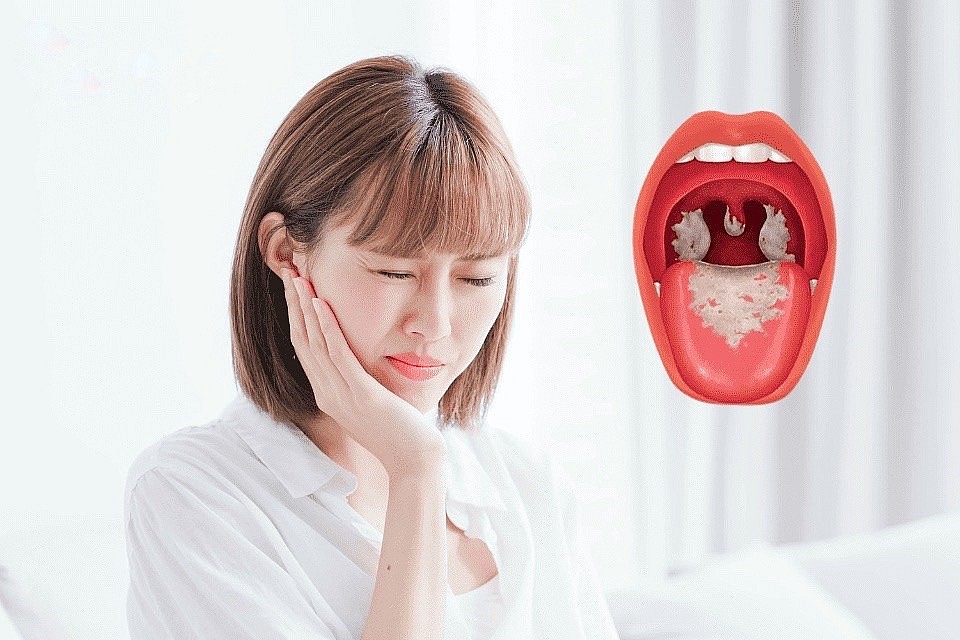 Chế độ dinh dưỡng cho người bệnh bạch hầu thế nào để đảm bảo sức khỏe? Chế độ dinh dưỡng cho người bệnh bạch hầu thế nào để đảm bảo sức khỏe?