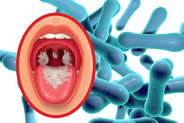 Bệnh bạch hầu là căn bệnh vừa nhiễm trùng vừa nhiễm độc ( Ảnh: VNVC) Bệnh bạch hầu là căn bệnh vừa nhiễm trùng vừa nhiễm độc ( Ảnh: VNVC)