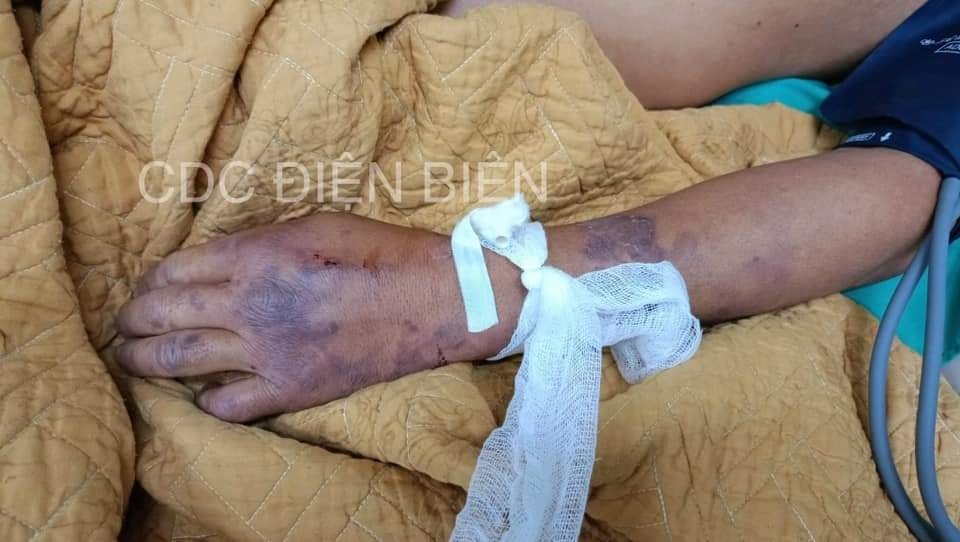 Nhiễm liên cầu khuẩn lợn, không chỉ do ăn tiết canh Nhiễm liên cầu khuẩn lợn, không chỉ do ăn tiết canh