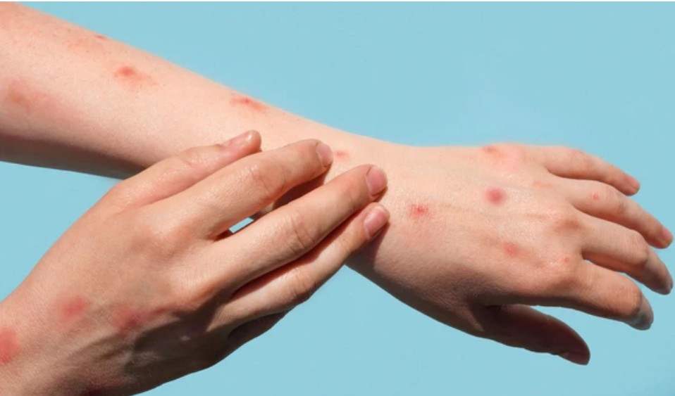 Bệnh đậu mùa khỉ được thông báo tình trạng khẩn cấp y tế toàn cầu Bệnh đậu mùa khỉ được thông báo tình trạng khẩn cấp y tế toàn cầu