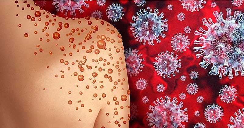 Bệnh đậu mùa khỉ là một vấn đề sức khỏe cộng đồng đáng lo ngại. Bệnh đậu mùa khỉ là một vấn đề sức khỏe cộng đồng đáng lo ngại.