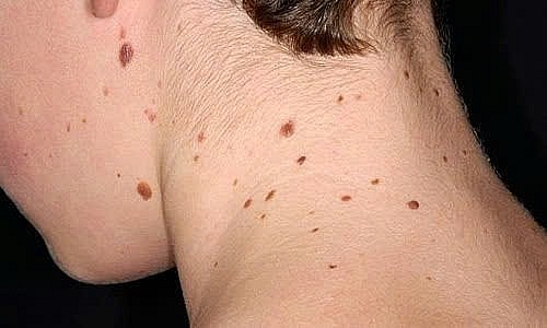 Ung thư da có thể nhận biết dễ dàng ngay trong giai đoạn đầu Ảnh: Medlatec Ung thư da có thể nhận biết dễ dàng ngay trong giai đoạn đầu Ảnh: Medlatec