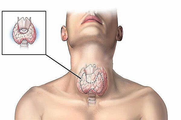Ung thư tuyến giáp phát triển chậm hơn những loại khác Ảnh: sức khoẻ đời sống Ung thư tuyến giáp phát triển chậm hơn những loại khác Ảnh: sức khoẻ đời sống