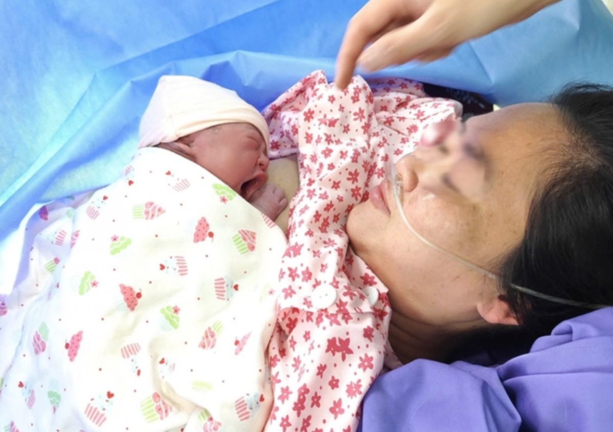 Em bé được ghép "da kề da" với mẹ. Ảnh: Bệnh viện cung cấp Em bé được ghép "da kề da" với mẹ. Ảnh: Bệnh viện cung cấp