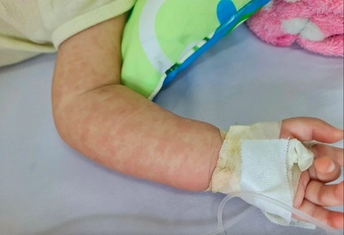 Trẻ mắc sởi, toàn thân phát ban. Ảnh: Lê Phương