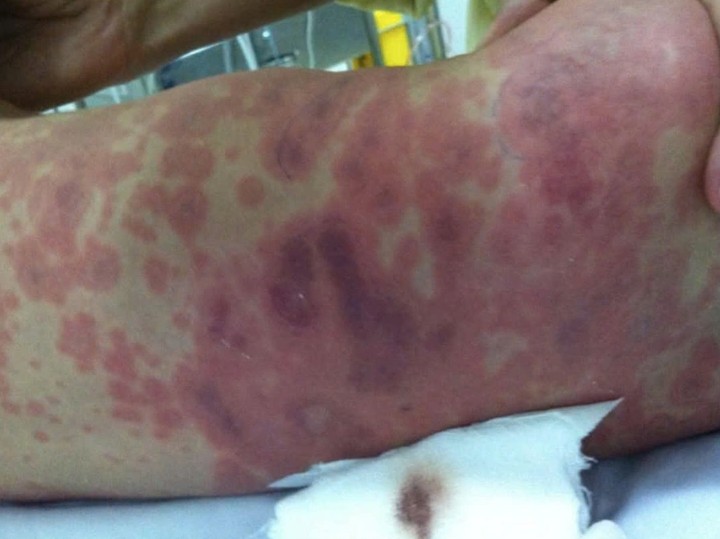 Đốm xuất huyết xuất hiện ở bệnh nhân mắc viêm não mô cầu - Ảnh minh họa của CDC Thái Bình Đốm xuất huyết xuất hiện ở bệnh nhân mắc viêm não mô cầu - Ảnh minh họa của CDC Thái Bình