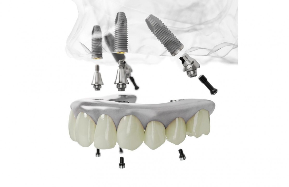 Trồng răng implant all on 4 tại Bệnh Viện Răng Hàm Mặt Sài Gòn Trồng răng implant all on 4 tại Bệnh Viện Răng Hàm Mặt Sài Gòn