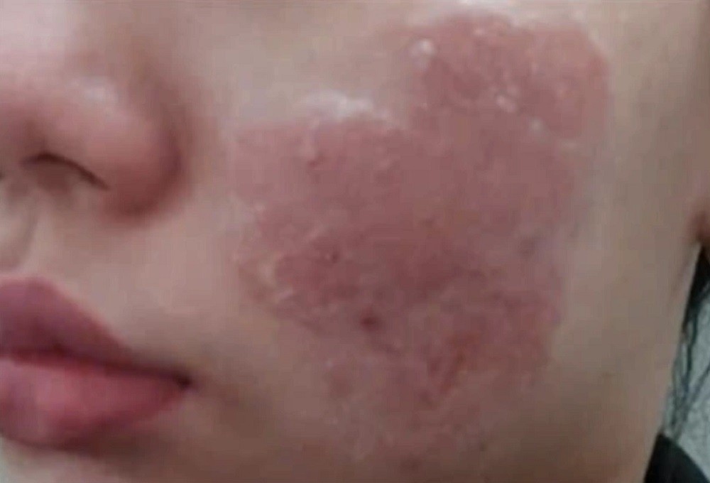 Làn da Hoa sau thời gian dùng cao trị mụn thảo dược không rõ nguồn gốc. Ảnh: Bác sĩ cung cấp Làn da Hoa sau thời gian dùng cao trị mụn thảo dược không rõ nguồn gốc. Ảnh: Bác sĩ cung cấp