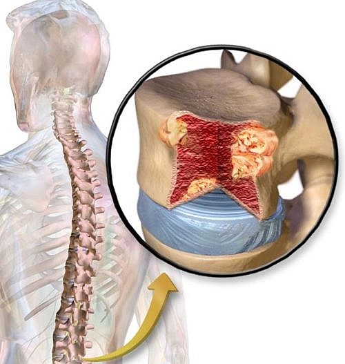 2951 suy tuy xuong e1542944162767