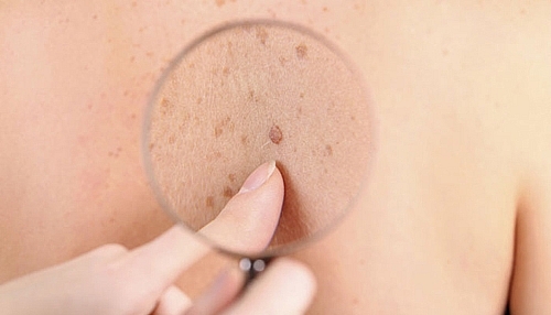 Lưu ý khi chăm sóc bệnh nhân xạ trị ung thư luu y khi cham soc benh nhan xa tri ung thu