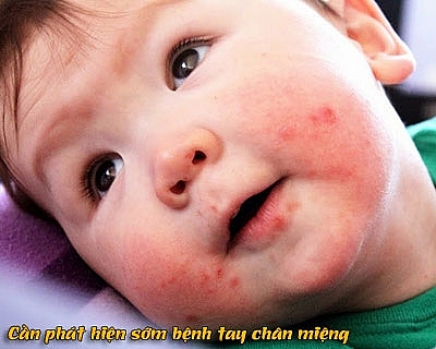 Hướng dẫn phòng & chăm sóc trẻ bị bệnh tay chân miệng huong dan phong cham soc tre bi benh tay chan mieng